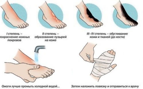 Помощь при ожогах в домашних условиях народными средствами Помощь при ожогах в домашних условиях народными средствами